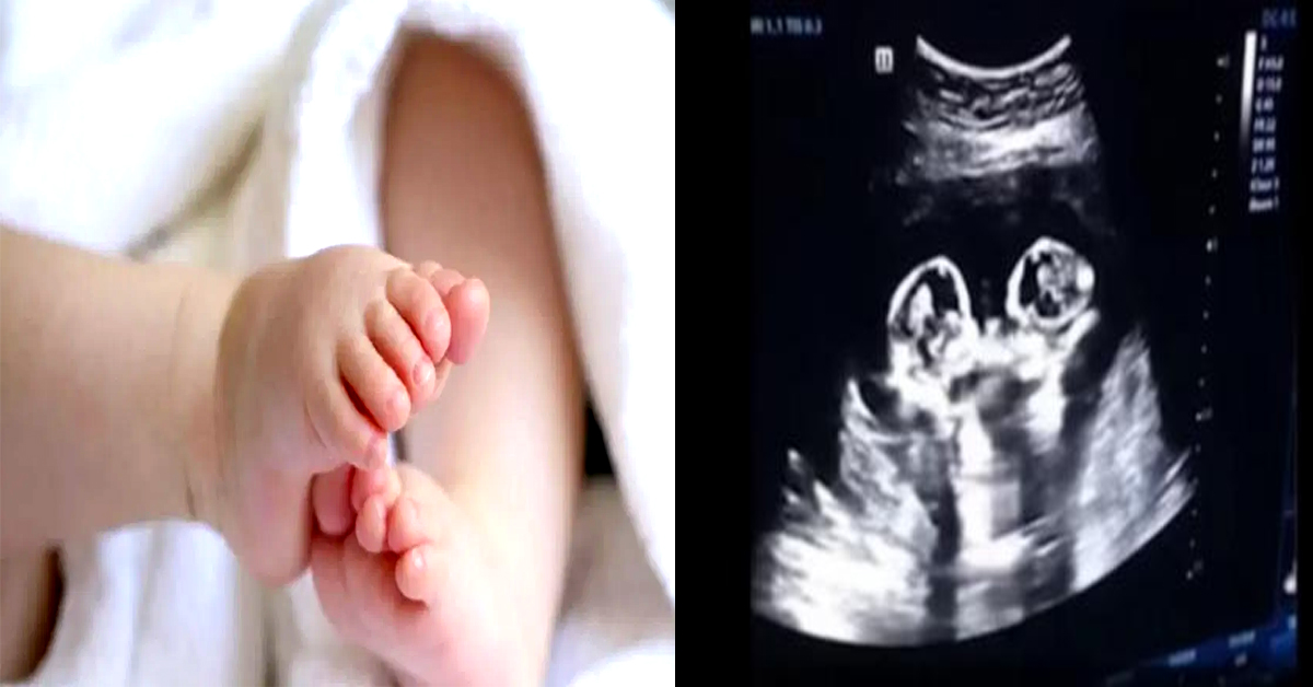 New Born Baby: 10 నెలల చిన్నారి కడుపులో కవలలు..ఆశ్చర్యపోయిన డాక్టర్లు!