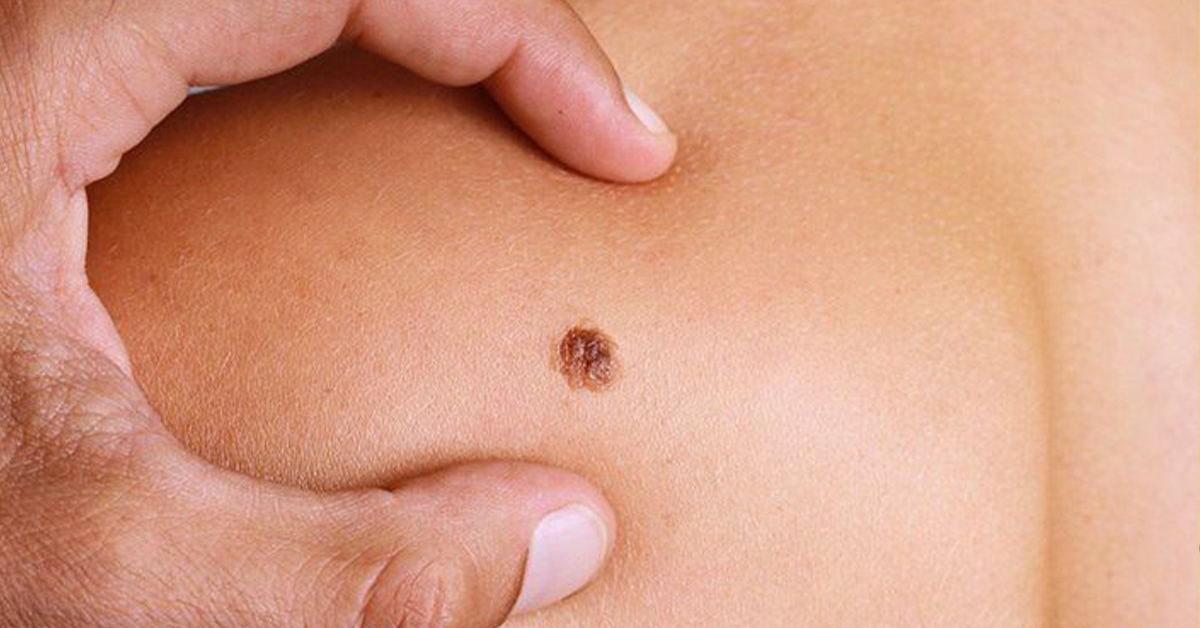 MELANOMA : ఆ క్యాన్సర్‌కు టీకా.. క్లినికల్‌ ట్రయల్స్‌ సక్సస్‌!