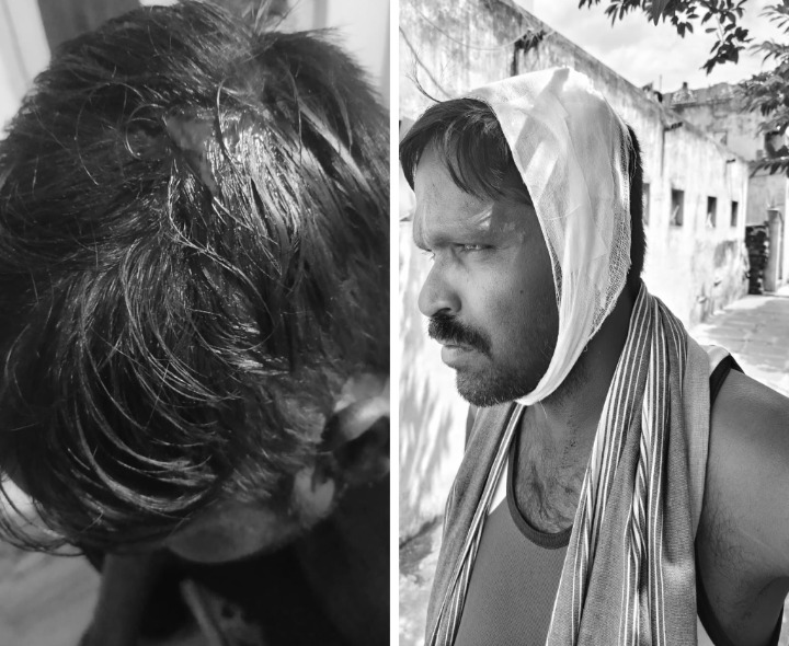 బీరు సీసాలతో దాడి.. పోలీసులకు ఫిర్యాదు